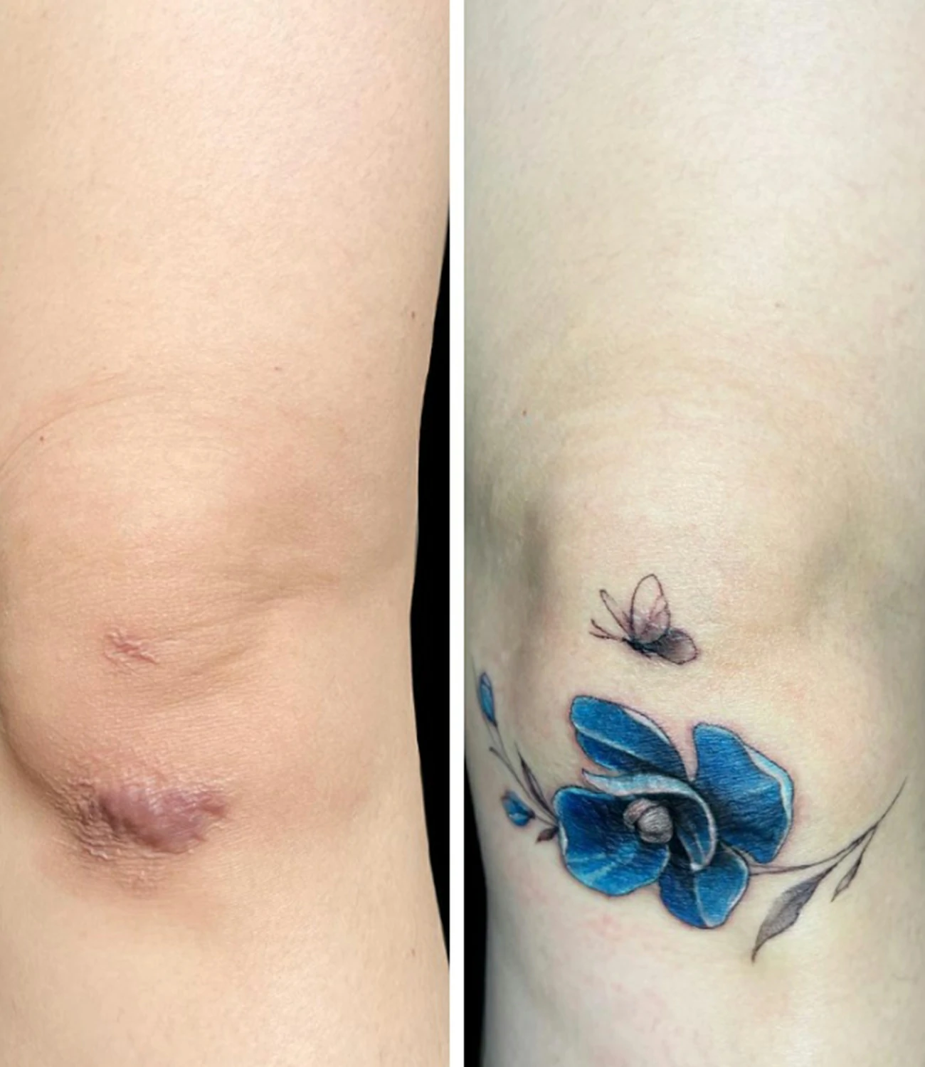 Knee Scar Tattoo